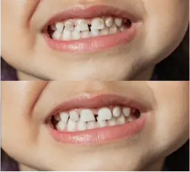 infantil-antes-despues-1