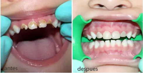 infantil-antes-despues-5