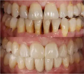 periodoncia-antes-despues-1