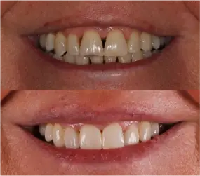 periodoncia-antes-despues-2