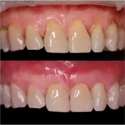 periodoncia-antes-despues-3