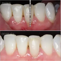 periodoncia-antes-despues-4