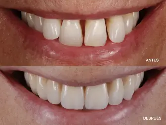 periodoncia-antes-despues-5