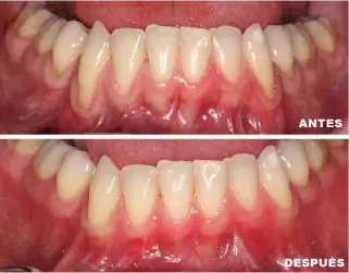 periodoncia-antes-despues-6